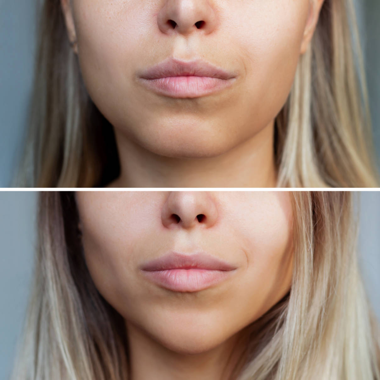Juvederm Ultra Smile - قبل وبعد حشو الشفاه